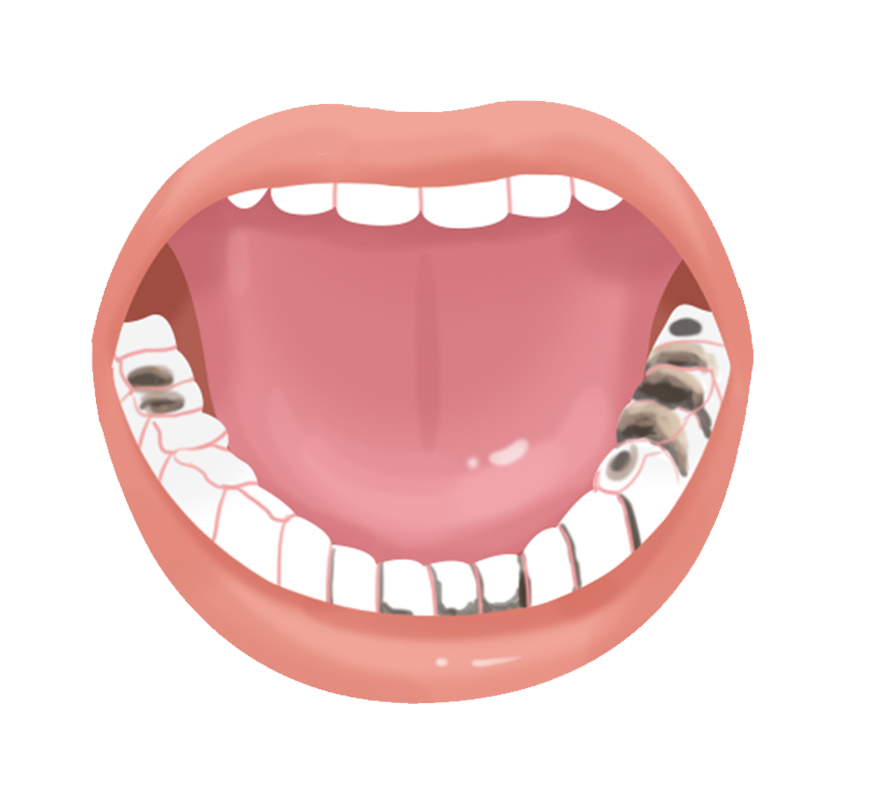 许昌口腔医院科普：如何区分是蛀牙了？还是牙上有黑色素？